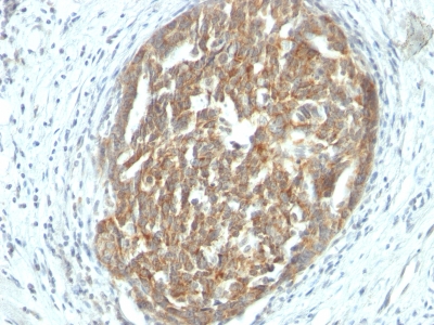FFPE human ovarian carcinoma sections stained with 100 ul anti-VEGF (clone SPM225) at 1:300. HIER epitope retrieval prior to staining was performed in 10mM Tris 1mM EDTA, pH 9.0.
